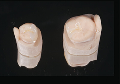 IOS ジルコニアインレー