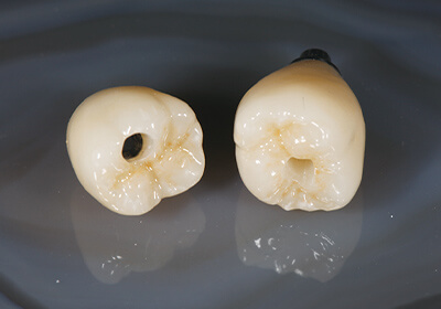 IOS スクリューリテインジルコニアクラウン