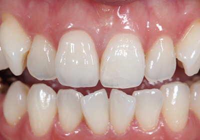 単冠（ジルコニア築盛）